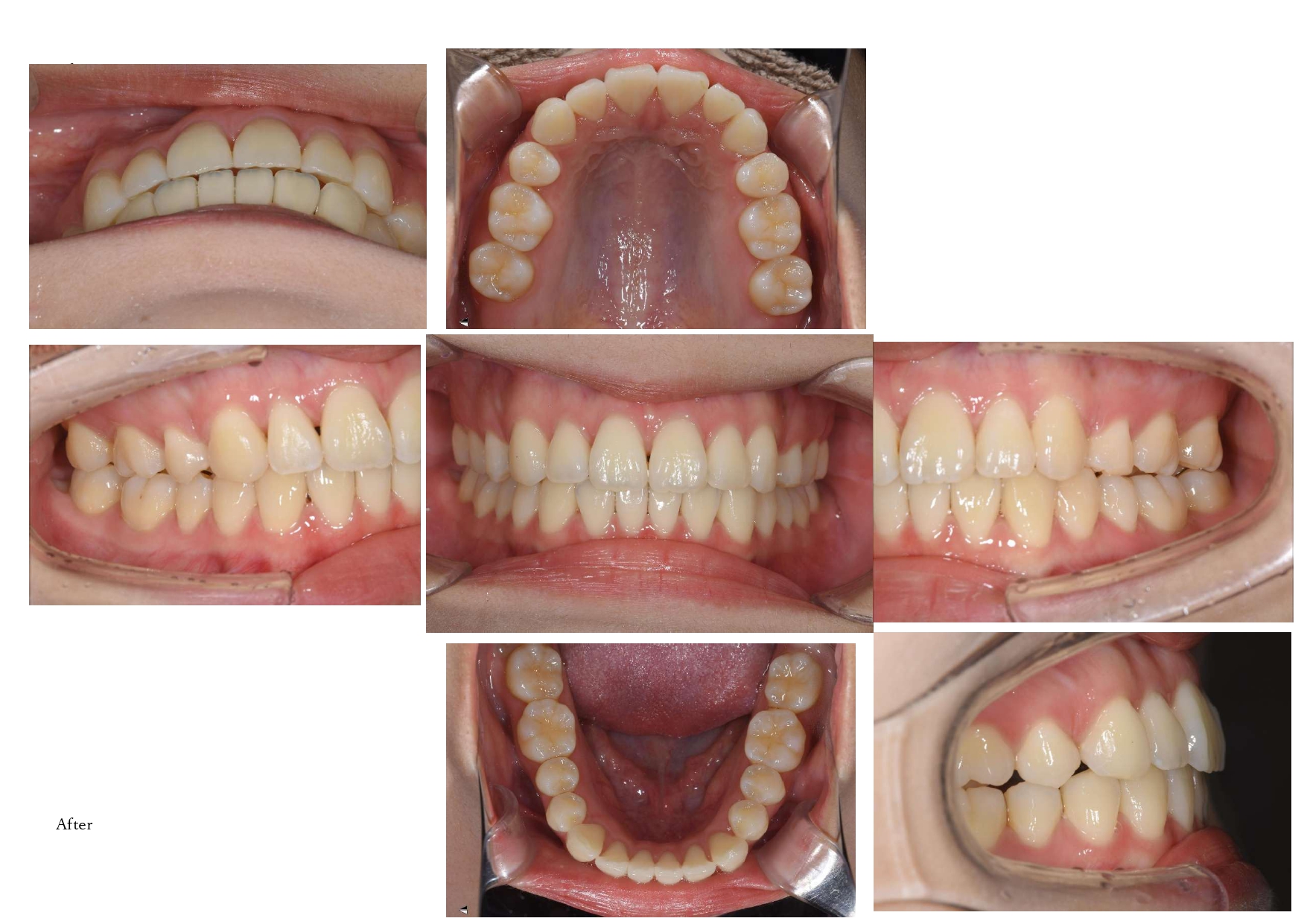 矯正治療　After